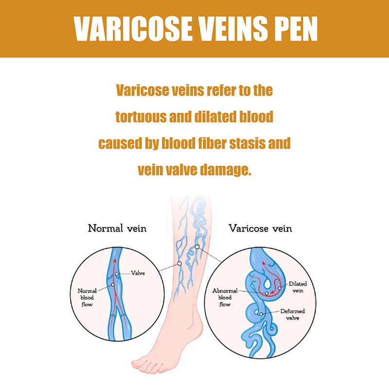 VeinErase Pro - Blue Light Laser for Varicose Vein Removal